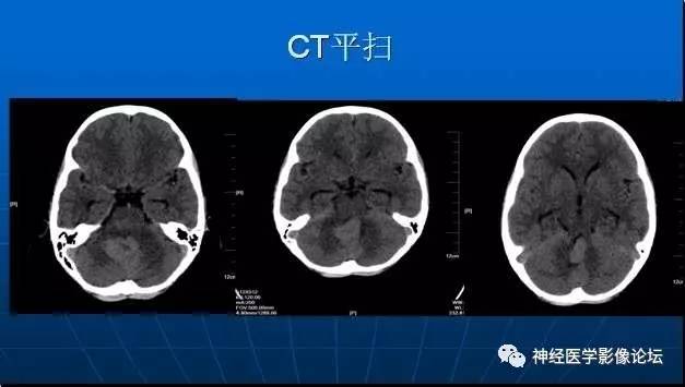 【病例】四脑室室管膜瘤1例MR 【病例】四脑室室管膜瘤1例MR