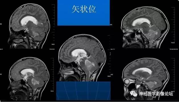 【病例】四脑室室管膜瘤1例MR 【病例】四脑室室管膜瘤1例MR