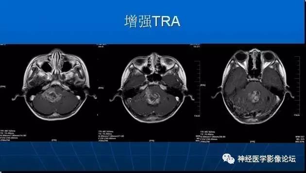 【病例】四脑室室管膜瘤1例MR 【病例】四脑室室管膜瘤1例MR