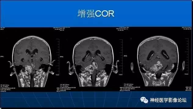【病例】四脑室室管膜瘤1例MR 【病例】四脑室室管膜瘤1例MR