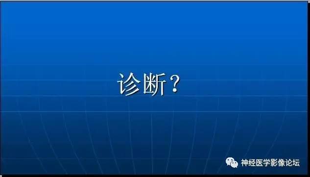 【病例】四脑室室管膜瘤1例MR 【病例】四脑室室管膜瘤1例MR