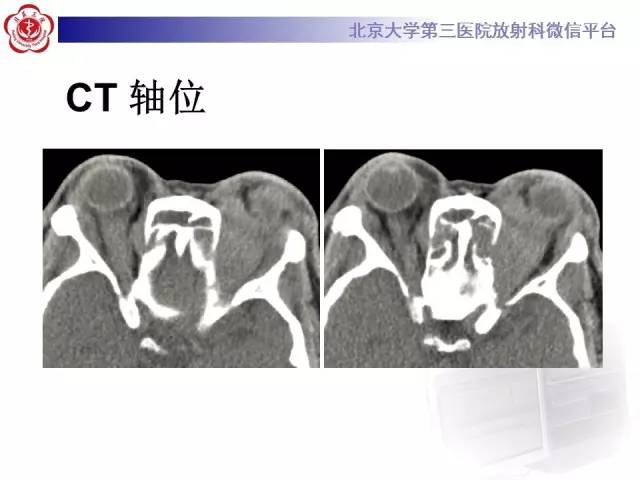 【病例】特发性眼眶炎性假瘤1例CT影像诊断