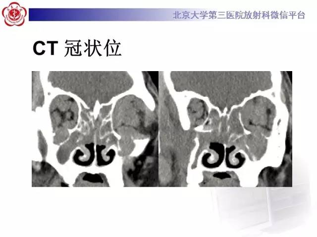 【病例】特发性眼眶炎性假瘤1例CT影像诊断