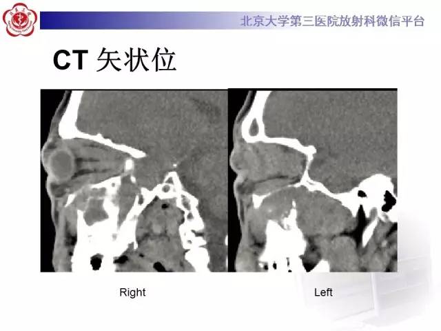 【病例】特发性眼眶炎性假瘤1例CT影像诊断