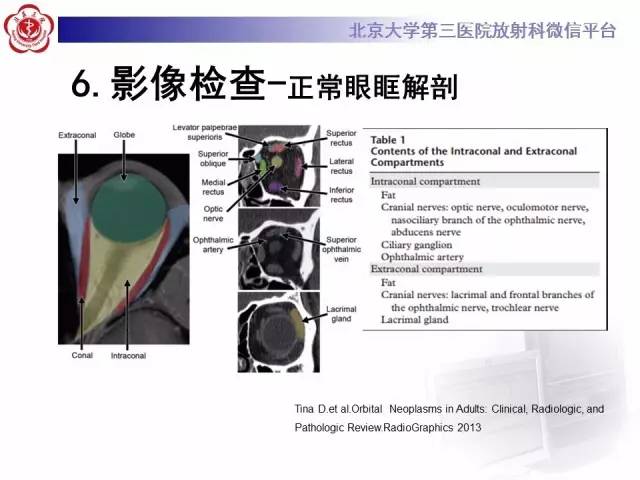 【病例】特发性眼眶炎性假瘤1例CT影像诊断