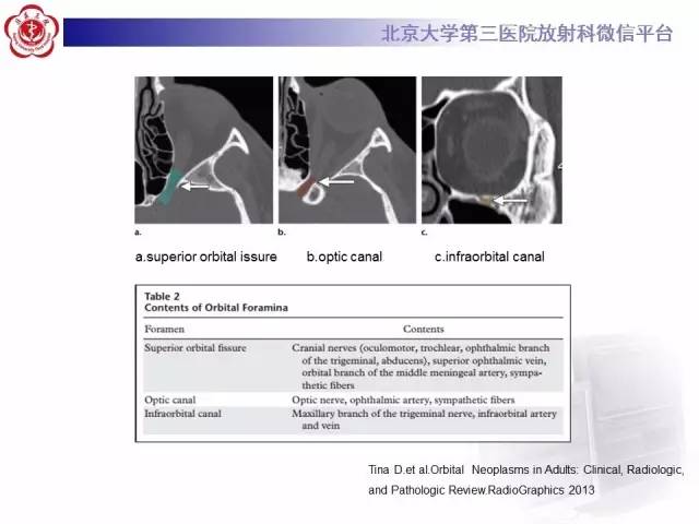 【病例】特发性眼眶炎性假瘤1例CT影像诊断