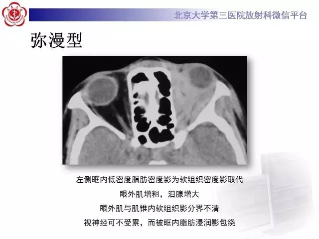 【病例】特发性眼眶炎性假瘤1例CT影像诊断