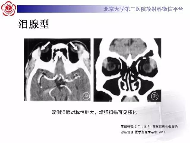 【病例】特发性眼眶炎性假瘤1例CT影像诊断