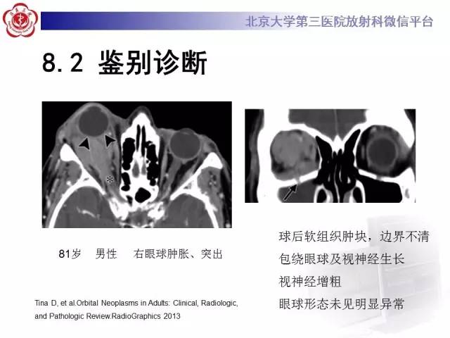 【病例】特发性眼眶炎性假瘤1例CT影像诊断
