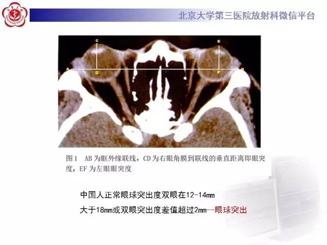 【病例】特发性眼眶炎性假瘤1例CT影像诊断