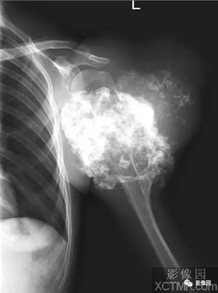 【病例】左肱骨上段骨软骨肉瘤1例X线CT影像诊断分析 【病例】左肱骨上段骨软骨肉瘤1例X线CT影像诊断分析