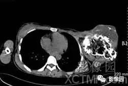 【病例】左肱骨上段骨软骨肉瘤1例X线CT影像诊断分析 【病例】左肱骨上段骨软骨肉瘤1例X线CT影像诊断分析