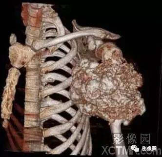 【病例】左肱骨上段骨软骨肉瘤1例X线CT影像诊断分析 【病例】左肱骨上段骨软骨肉瘤1例X线CT影像诊断分析
