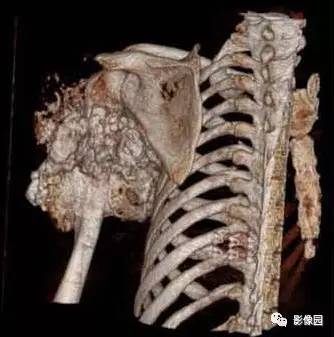 【病例】左肱骨上段骨软骨肉瘤1例X线CT影像诊断分析 【病例】左肱骨上段骨软骨肉瘤1例X线CT影像诊断分析