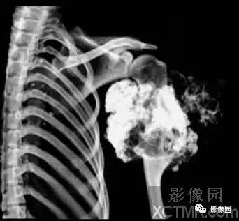【病例】左肱骨上段骨软骨肉瘤1例X线CT影像诊断分析 【病例】左肱骨上段骨软骨肉瘤1例X线CT影像诊断分析