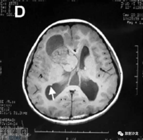 【病例】室管膜下巨细胞星形细胞瘤1例CT及MR影像表现 【病例】室管膜下巨细胞星形细胞瘤1例CT及MR影像表现