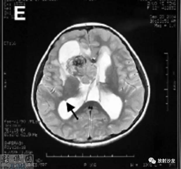 【病例】室管膜下巨细胞星形细胞瘤1例CT及MR影像表现 【病例】室管膜下巨细胞星形细胞瘤1例CT及MR影像表现