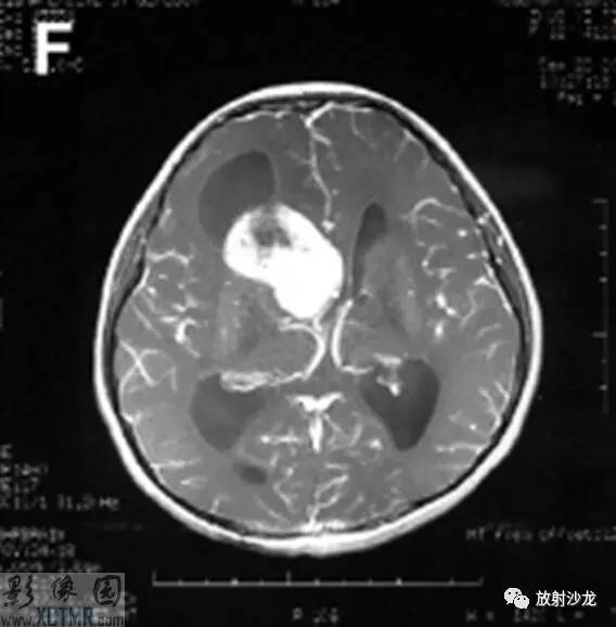 【病例】室管膜下巨细胞星形细胞瘤1例CT及MR影像表现 【病例】室管膜下巨细胞星形细胞瘤1例CT及MR影像表现