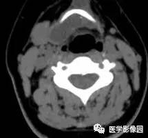 【病例】甲状舌管囊肿伴恶变1例CT影像表现 【病例】甲状舌管囊肿伴恶变1例CT影像表现