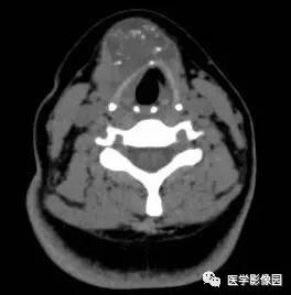 【病例】甲状舌管囊肿伴恶变1例CT影像表现 【病例】甲状舌管囊肿伴恶变1例CT影像表现