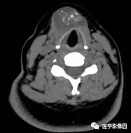 【病例】甲状舌管囊肿伴恶变1例CT影像表现 【病例】甲状舌管囊肿伴恶变1例CT影像表现