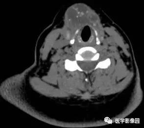 【病例】甲状舌管囊肿伴恶变1例CT影像表现 【病例】甲状舌管囊肿伴恶变1例CT影像表现