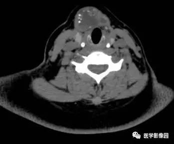 【病例】甲状舌管囊肿伴恶变1例CT影像表现 【病例】甲状舌管囊肿伴恶变1例CT影像表现