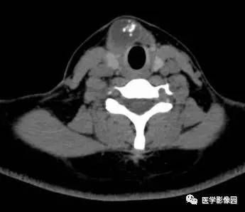 【病例】甲状舌管囊肿伴恶变1例CT影像表现 【病例】甲状舌管囊肿伴恶变1例CT影像表现