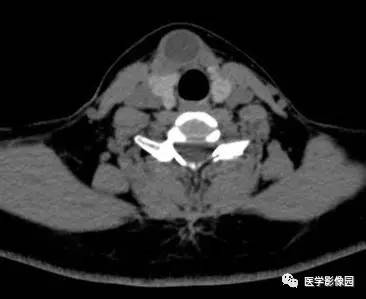 【病例】甲状舌管囊肿伴恶变1例CT影像表现 【病例】甲状舌管囊肿伴恶变1例CT影像表现