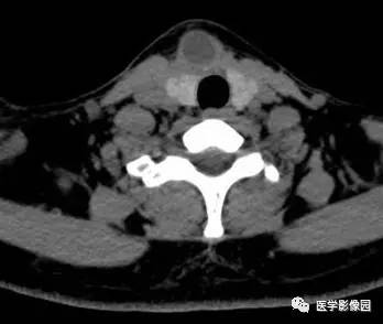 【病例】甲状舌管囊肿伴恶变1例CT影像表现 【病例】甲状舌管囊肿伴恶变1例CT影像表现