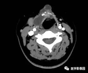 【病例】甲状舌管囊肿伴恶变1例CT影像表现 【病例】甲状舌管囊肿伴恶变1例CT影像表现