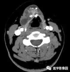 【病例】甲状舌管囊肿伴恶变1例CT影像表现 【病例】甲状舌管囊肿伴恶变1例CT影像表现