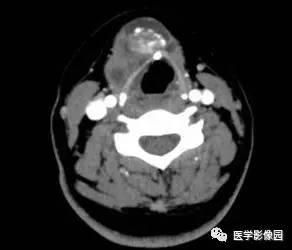 【病例】甲状舌管囊肿伴恶变1例CT影像表现 【病例】甲状舌管囊肿伴恶变1例CT影像表现