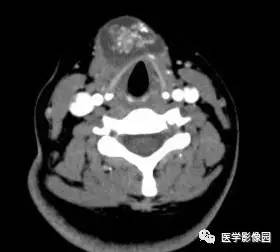 【病例】甲状舌管囊肿伴恶变1例CT影像表现