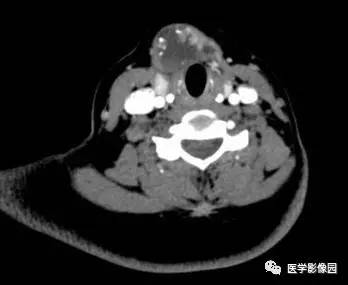 【病例】甲状舌管囊肿伴恶变1例CT影像表现 【病例】甲状舌管囊肿伴恶变1例CT影像表现