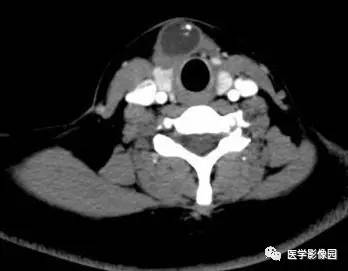 【病例】甲状舌管囊肿伴恶变1例CT影像表现 【病例】甲状舌管囊肿伴恶变1例CT影像表现