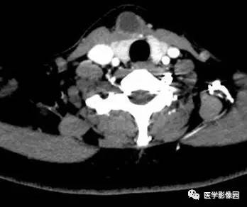 【病例】甲状舌管囊肿伴恶变1例CT影像表现 【病例】甲状舌管囊肿伴恶变1例CT影像表现
