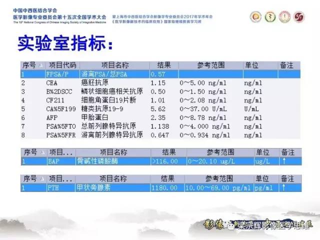 【病例】甲状旁腺功能亢进棕色瘤1例X线CT