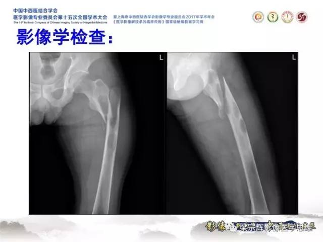 【病例】甲状旁腺功能亢进棕色瘤1例X线CT