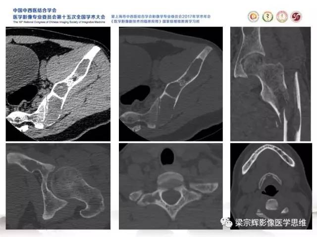 【病例】甲状旁腺功能亢进棕色瘤1例X线CT