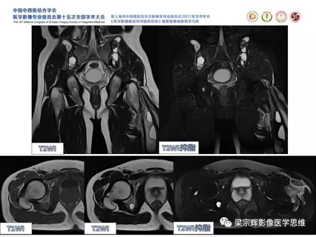 【病例】甲状旁腺功能亢进棕色瘤1例X线CT
