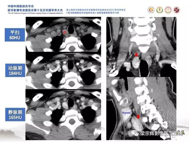 【病例】甲状旁腺功能亢进棕色瘤1例X线CT