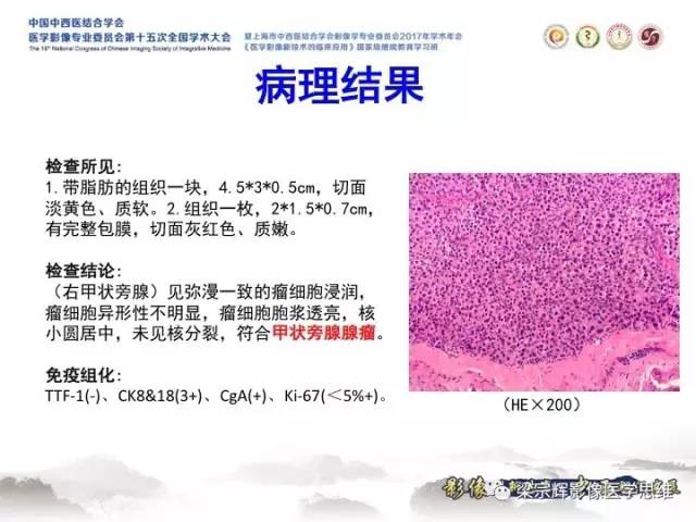 【病例】甲状旁腺功能亢进棕色瘤1例X线CT