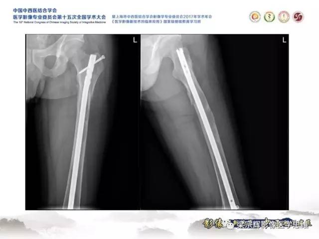 【病例】甲状旁腺功能亢进棕色瘤1例X线CT