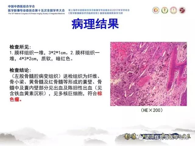 【病例】甲状旁腺功能亢进棕色瘤1例X线CT