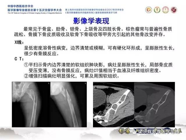 【病例】甲状旁腺功能亢进棕色瘤1例X线CT