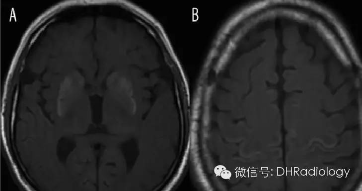 颅内TIWI高信号病变最全讲解 颅内TIWI高信号病变最全讲解