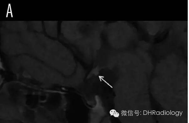颅内TIWI高信号病变最全讲解 颅内TIWI高信号病变最全讲解