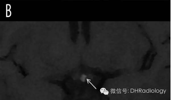 颅内TIWI高信号病变最全讲解 颅内TIWI高信号病变最全讲解