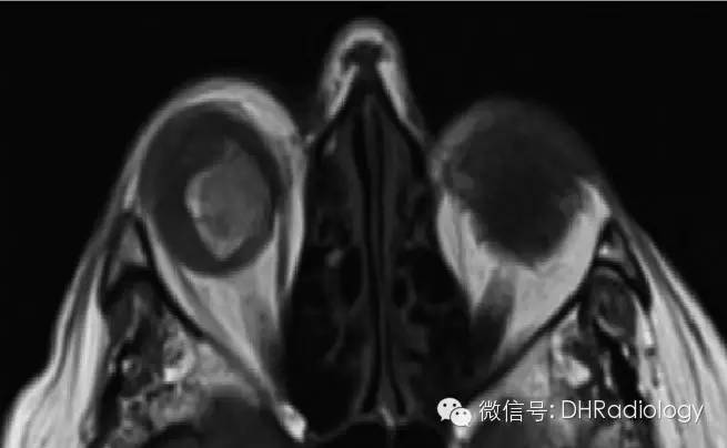 颅内TIWI高信号病变最全讲解 颅内TIWI高信号病变最全讲解